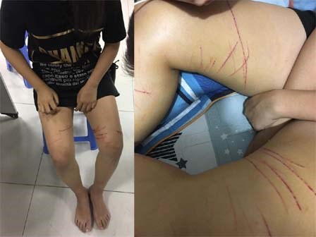 Nghi vấn cô gái trẻ bị kẻ “biến thái” quấy rối, dùng dao lam rạch nhiều vết vào đùi?