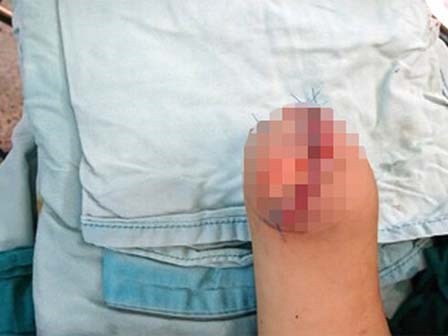 Bé trai 3 tuổi mất một mắt và một bàn tay vì cục sạc gắn thêm cho xe máy