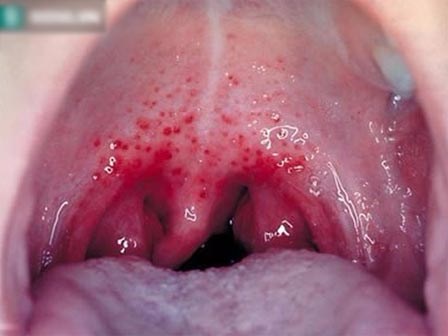 Nghẹt mũi, ù tai: Dấu hiệu của 1 trong 5 loại ung thư phổ biến nhất hiện nay ở Việt Nam