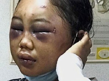 Nữ giúp việc 19 tuổi người Indonesia bị bà chủ Malaysia bạo hành dã man