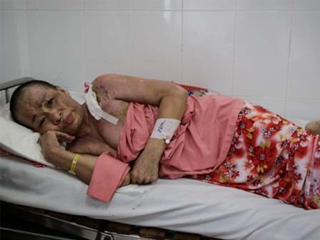 Không móc cống nghẹt, người phụ nữ bị tạt nồi thịt sôi vào người gây bỏng nặng