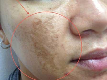 Chỉ cần dùng cơm như thế này nám, tàn nhang cứng đầu đến đâu cũng bị đánh bại