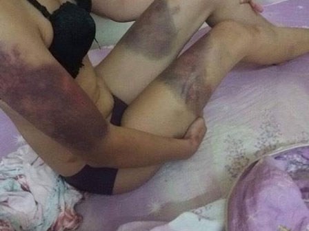 Hà Nội: Cô gái trẻ “tố” bị bạn trai ghen tuông, đánh đập thâm tím hết cả người