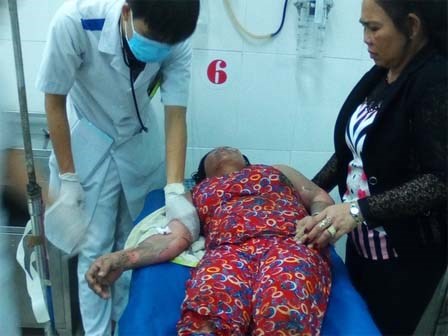 Bật bếp gas nấu nước tắm buổi tối, 1 phụ nữ nguy kịch
