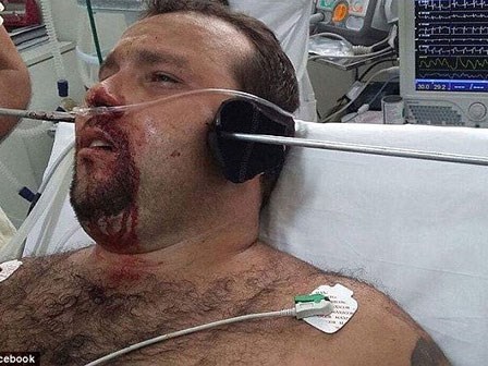 Ngư dân sống sót kỳ diệu dù bị thanh sắt xuyên qua đầu