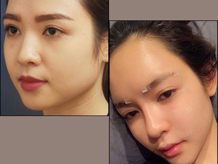 Bơm mỡ vào mặt như cô dâu Cao Bằng 62 tuổi: Có thực sự cải lão hoàn đồng?-5