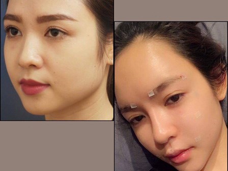 Cấy mỡ tự thân - Phương pháp làm đẹp