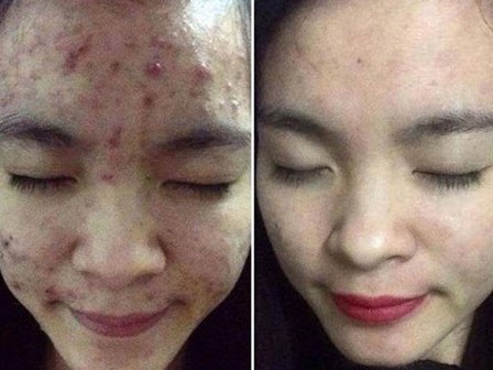 Kết hợp thứ này với rau diếp cá giã nát, mụn cứng đầu đến đâu cũng hết sạch đến đó