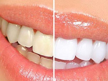 Tẩy trắng răng ai nên, ai không?