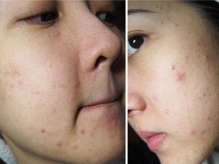 99% chị em mắc phải 5 thói quen này khiến mụn mọc như nở hoa trên mặt