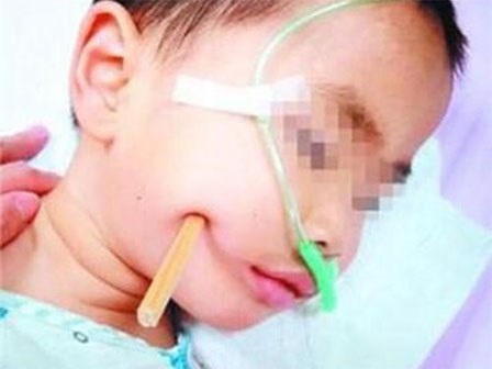 Nếu bạn vẫn còn nghĩ đũa ăn vô hại với trẻ nhỏ thì hãy xem những tai nạn kinh hoàng này