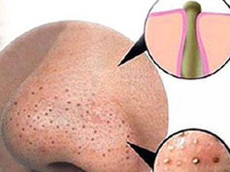 Chỉ 1 chiếc ruột bút bi, mụn đầu đen cứng đầu đến đâu cũng chui ra hết đến đấy