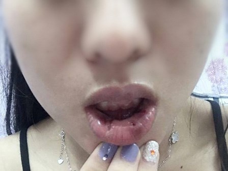 Hà Nội: Bơm môi hình trái tim, cô gái trẻ hoảng hồn khi phát hiện 18