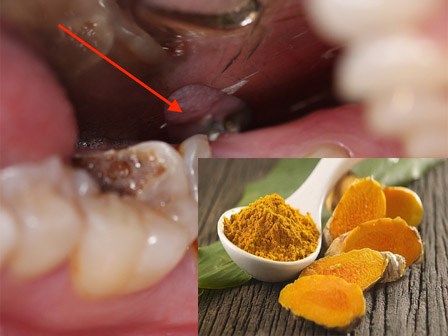 Những phương thuốc tự nhiên này sẽ giúp bạn chữa sâu răng hiệu quả ngay tại nhà