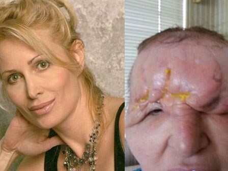 Mặt biến dạng khủng khiếp sau tiêm chất làm đầy của người phụ nữ xinh đẹp