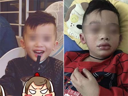 Mùng 3 Tết, bé trai nhập viện trong tình trạng mặt mũi sưng vù vì uống trà sữa?