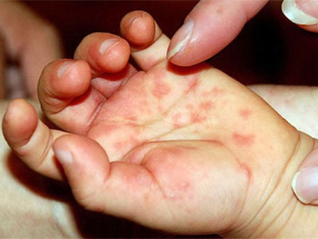 Dịch tay chân miệng lan rộng, dấu hiệu nào nhận biết bệnh sớm nhất?