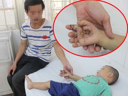 Nghịch bóng đèn bàn thờ ông Địa, bé trai 23 tháng tuổi bị bỏng nặng bàn tay