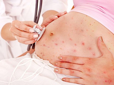 Đã vào mùa thủy đậu: Căn bệnh gây biến chứng nặng nề không được coi thường