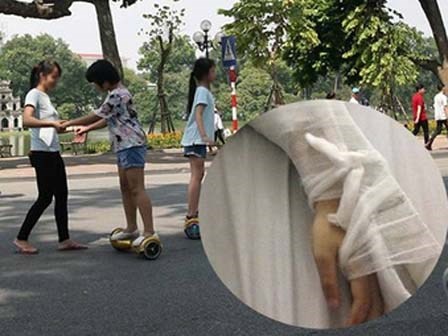 Bé trai 8 tuổi gãy tay khi chơi xe điện tự cân bằng ở phố đi bộ