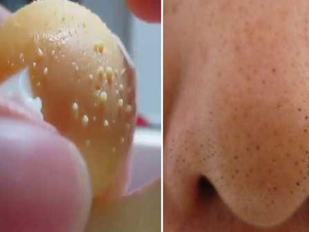Lăn mặt bằng trứng gà luộc: chưa kịp sạch mụn đã bị viêm da
