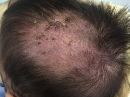 Xót xa bé trai chào đời bị da vảy cá, toàn thân bao phủ vảy trắng với nhiều vết rạn chảy máu-2