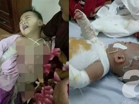 Mẹ bất cẩn, con trai 2 tuổi ngã vào nồi nước sôi bỏng toàn thân