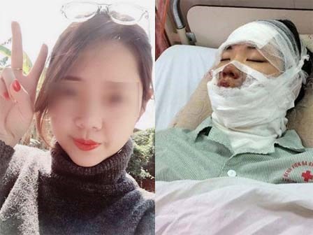Cô gái xinh đẹp bị bỏng toàn bộ gương mặt khi 55 quả bóng bay trên tay bất ngờ phát nổ