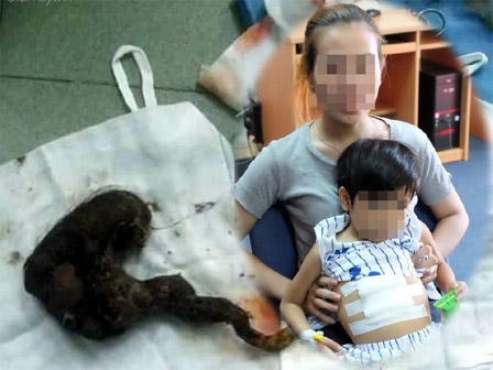 Phát hiện búi tóc khủng nặng 1kg ở trong dạ dày bé gái 11 tuổi-2