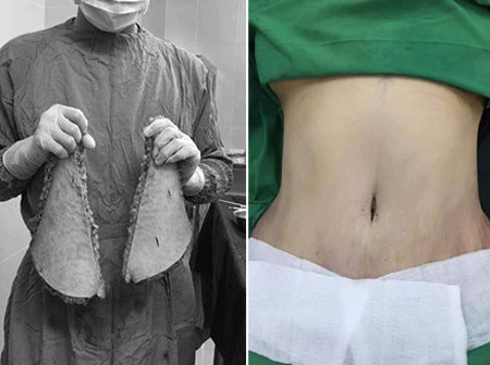 Xót xa mẹ 1 con đại phẫu làm đẹp