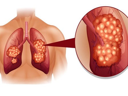 5 loại ung thư khó phát hiện sớm nhất hiện nay: Cẩn trọng không bao giờ thừa!
