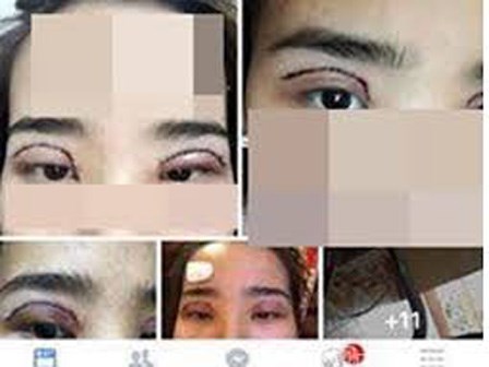 Chạy theo mốt cắt mí, cô gái đau xót khi 7 ngày sau mắt nhiễm trùng, nếp mí hỏng hẳn