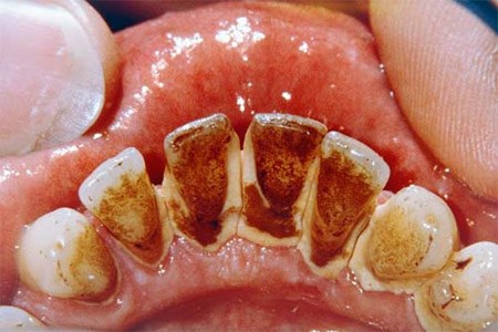 Mảng bám, ố vàng hết sạch trong tích tắc với 2 công thức chưa đến 10 ngàn đồng