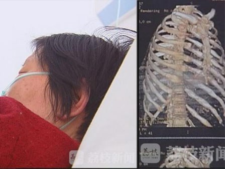 Bà mẹ U70 bị con trai ruột đánh gãy 11 chiếc xương sườn, thủng màng nhĩ tai trái