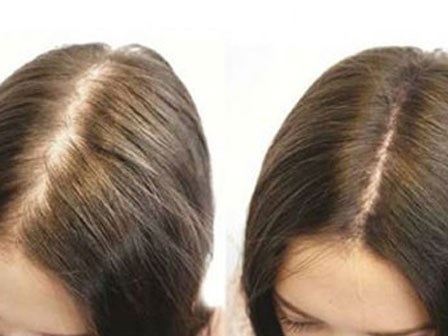 Nửa đầu tóc mọc lại trong 2 tháng nhờ vitamin già trẻ đều dùng