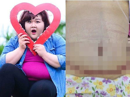 Á quân Bước nhảy ngàn cân Thủy Tiên khoe ảnh cắt mỡ bụng gây sốc