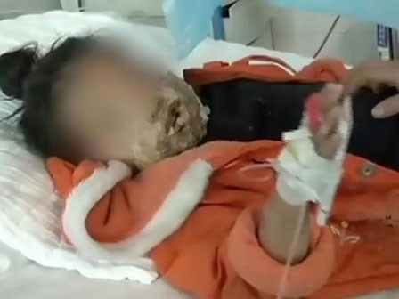 Bé gái 4 tuổi bị biến dạng khuôn mặt vì điện thoại của cha nổ khi đang sạc