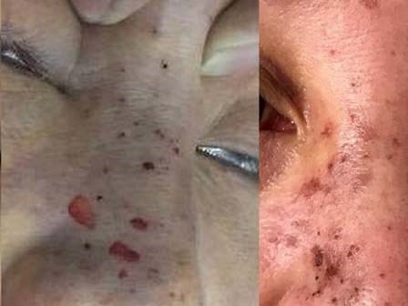 Mặt, mũi bị hoại tử sau khi tiêm filler để làm đẹp