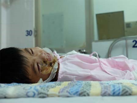 Thương tâm bé trai 5 tuổi bị điện giật khiến hoại tử nặng hai bàn tay