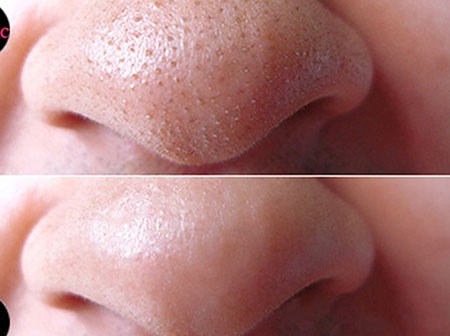 Lột sạch mụn cám, mụn đầu đen chỉ bằng nắm lá này xay nhuyễn