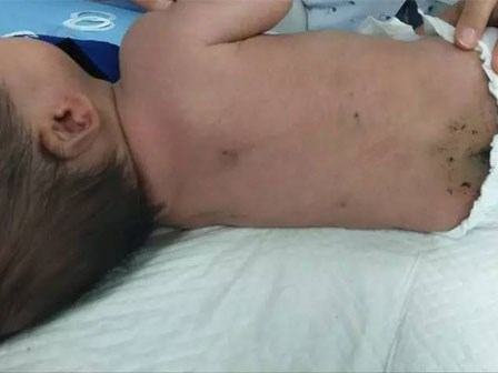 Bé sơ sinh 40 ngày tuổi bị đâm 30 mũi kim vì bà ngoại tin bài thuốc dân gian