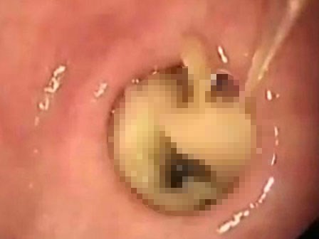 Video: Nấm mọc trong dạ dày, người phụ nữ tá hỏa nhập viện gấp