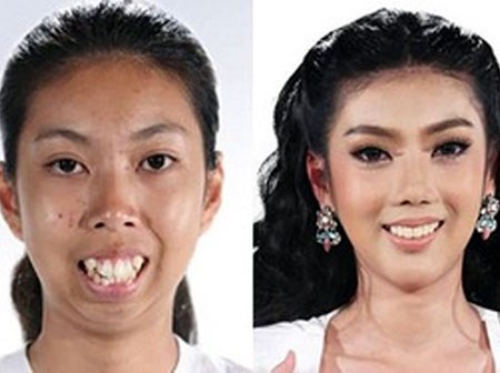 Màn vịt hóa thiên nga ngoạn mục của cô gái Thái không cằm, răng hô khiến dân tình sửng sốt