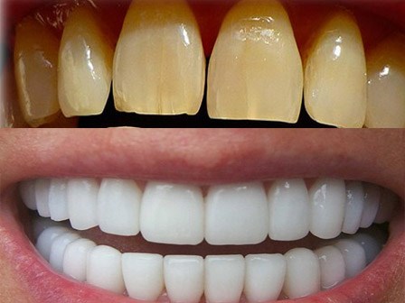 Cao răng, mảng bám ố vàng cứng như đá cũng bong ra nhờ trộn oxy già với thứ này