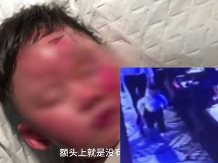 Bé trai 3 tuổi chạy trong nhà hàng bị nồi lẩu nóng đổ vào người