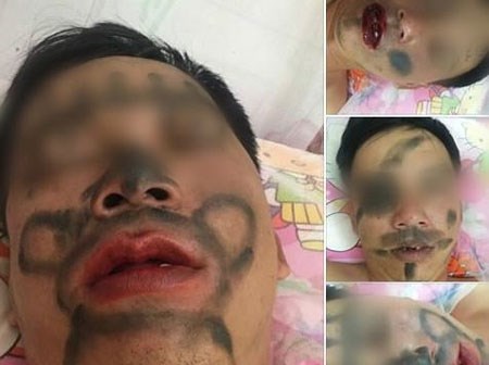 Người vợ vẽ chằng chịt lên mặt chồng vì nhiều lần nhậu say