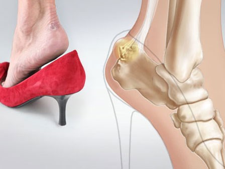 Giày dép là đam mê của phái đẹp, nhưng những kiểu giày nguy hiểm này thì nên tránh