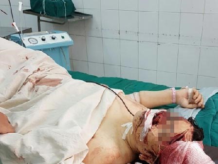 Nghi án chồng chém vợ vỡ sọ não rồi cứa cổ tự sát