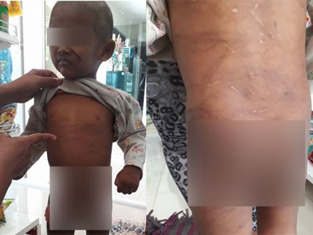 Thương tâm cậu bé bị cha dượng đánh đập tàn nhẫn, châm thuốc lá lên mặt