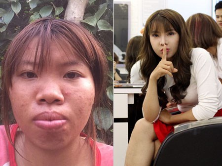 Hình ảnh nhan sắc hoàn thiện sau phẫu thuật thẩm mỹ của Phượng